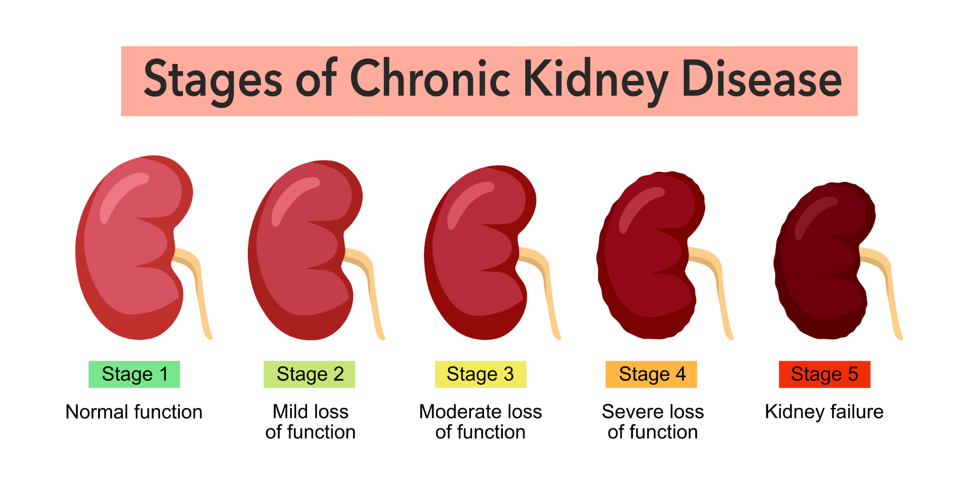 Chronic Kidney Disease Has No Symptoms Until It Is Already Advanced image